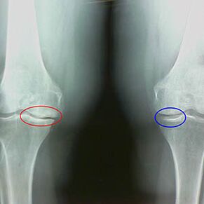 Belauneko artikulazioaren artrosia erradiografian